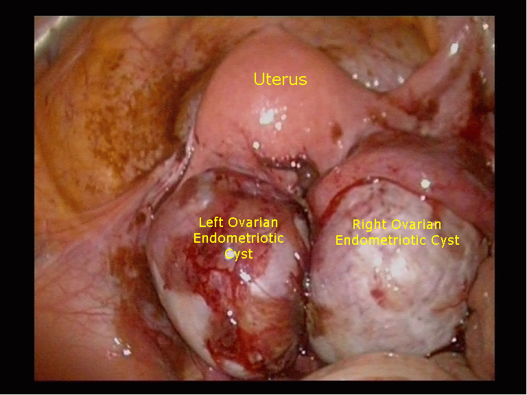 Rigt Left Ovarian Endometriotic Cysts